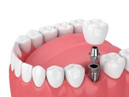 DENTAL IMPLANTS