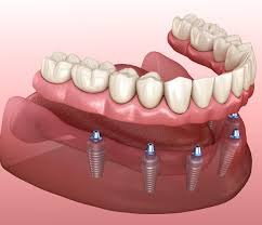 DENTAL IMPLANTS